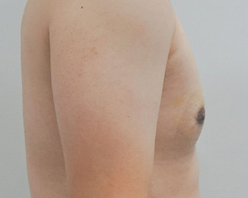 Gynecomastia Surgery